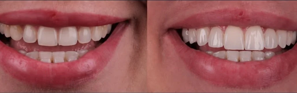 Caso clínico 1, comparação do sorriso antes e depois