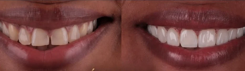 Caso clínico 2, comparação do sorriso antes e depois