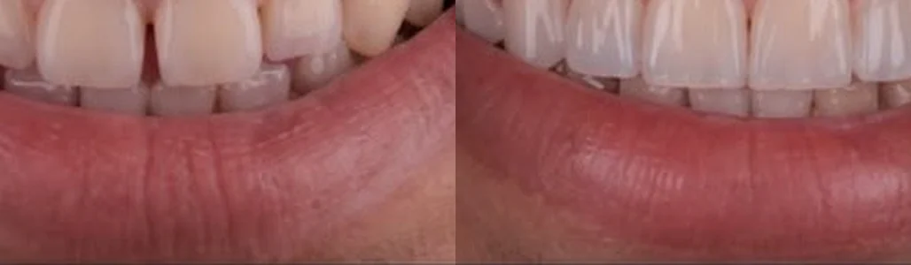 Caso clínico 3, comparação do sorriso antes e depois