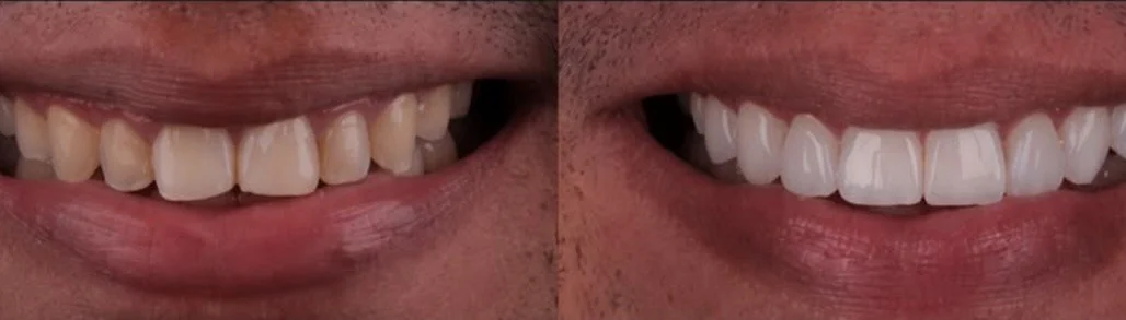 Caso clínico 4, comparação do sorriso antes e depois